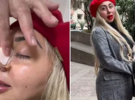 Naya Fácil mostró los resultados de su operación a la nariz