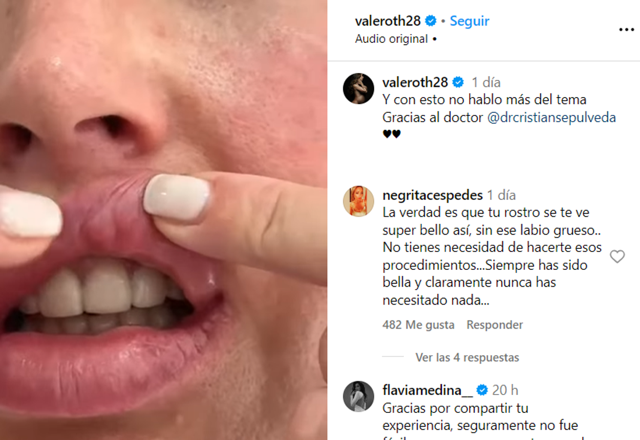 Vale Roth le mostró a sus seguidores las consecuencias de un mal procedimiento estético