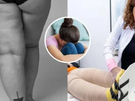 Detecta las primeras señales de lipedema en niñas y evita confusiones con la obesidad.