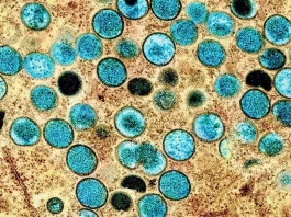 Explorando los riesgos y desafíos de la emergencia sanitaria por la viruela del mono.