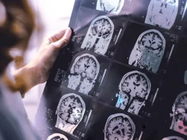 Investigadores hallan posible vínculo entre esclerosis múltiple y Alzheimer.