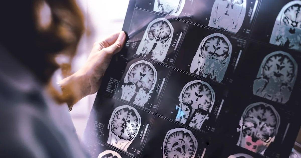 Investigadores hallan posible vínculo entre esclerosis múltiple y Alzheimer. Investigadores hallan posible vínculo entre esclerosis múltiple y Alzheimer.