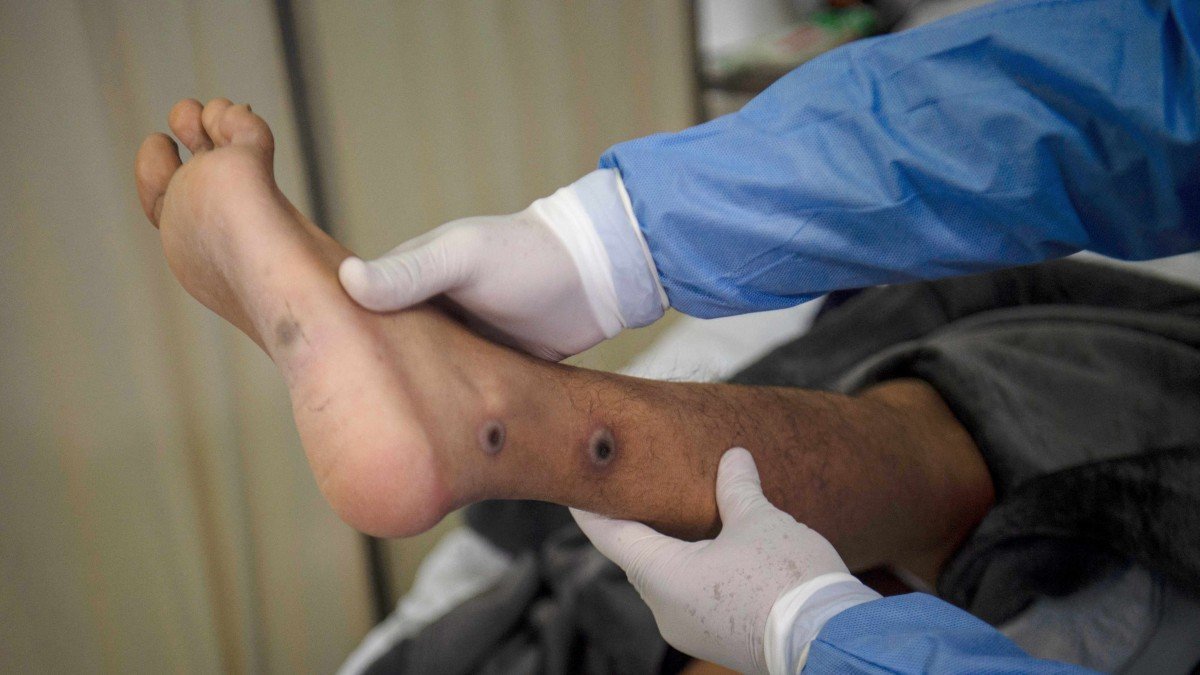 Pakistán reporta su primer caso de viruela del mono