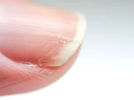 Descubre cómo identificar y tratar los hongos en las uñas de manera efectiva.