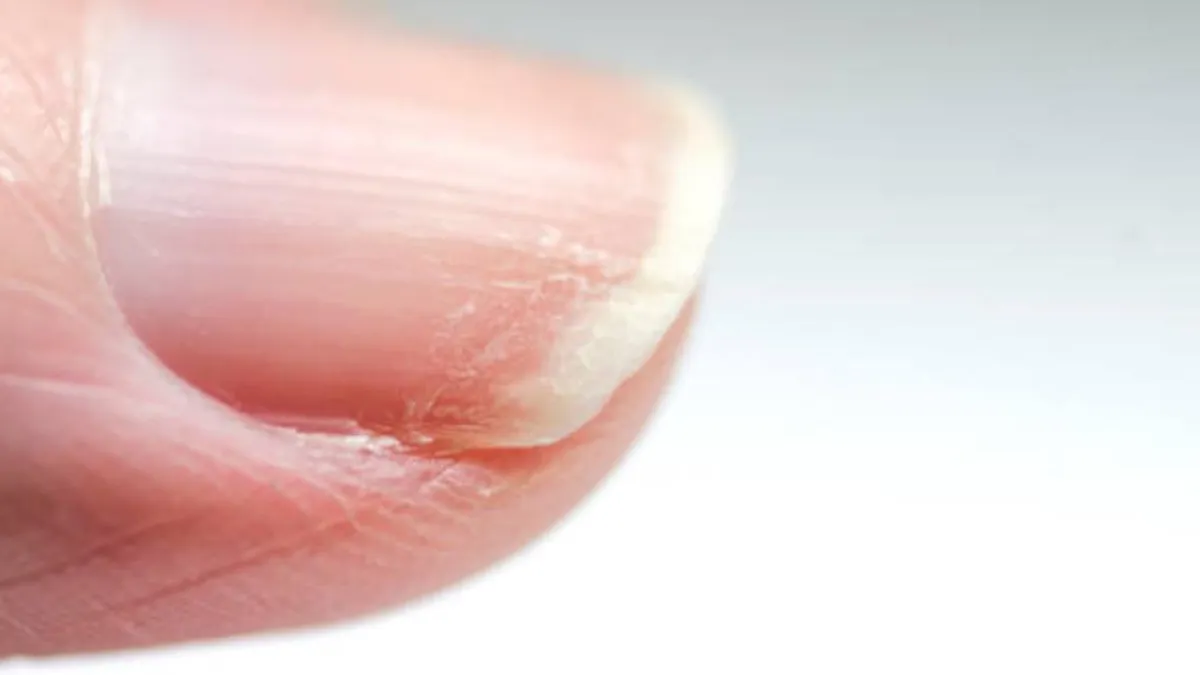 Descubre cómo identificar y tratar los hongos en las uñas de manera efectiva.