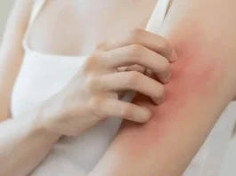 Explorando las barreras en el acceso al tratamiento de la dermatitis atópica.