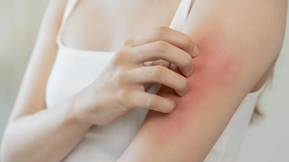 Explorando las barreras en el acceso al tratamiento de la dermatitis atópica.