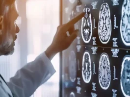 Estudio revela vínculo entre el tamaño de la red cerebral de atención y la depresión.