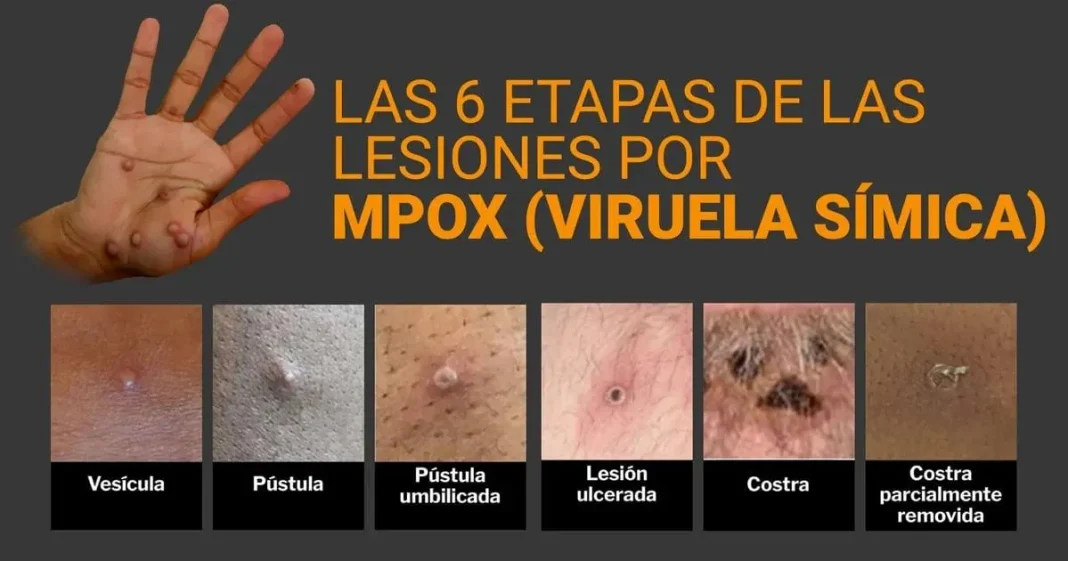 Síntomas de la viruela del mono y grupos vulnerables: información clave para la salud.