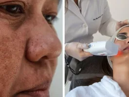 Descubre los tratamientos más efectivos y cómo prevenir las manchas en la piel.