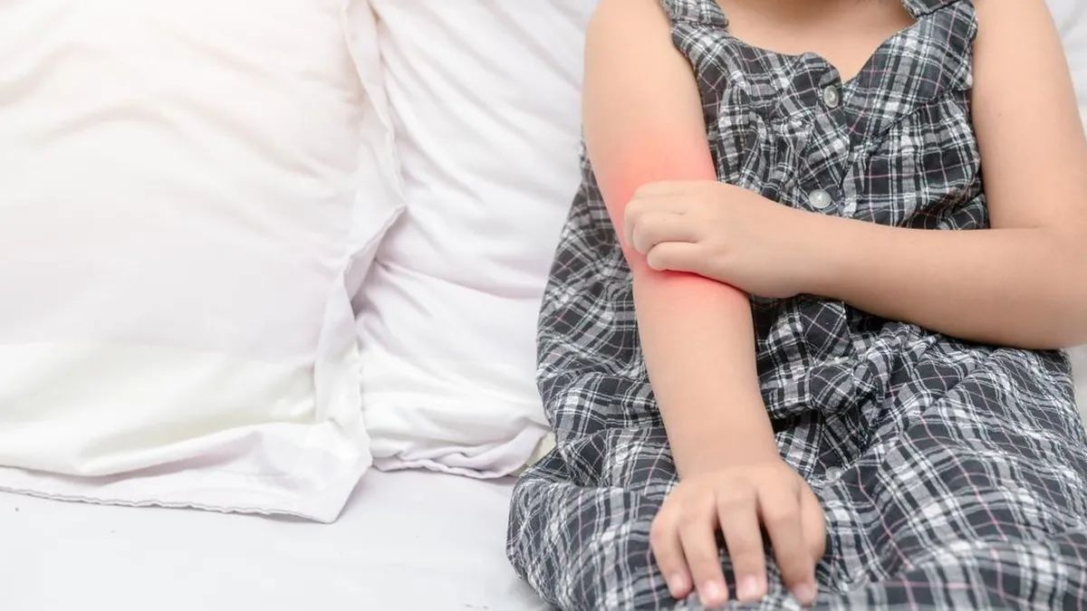 Explorando la efectividad de las dietas de exclusión en el eczema infantil.