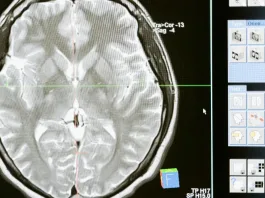 Nuevo modelo de IA detecta tumores cerebrales indetectables en solo 10 segundos.