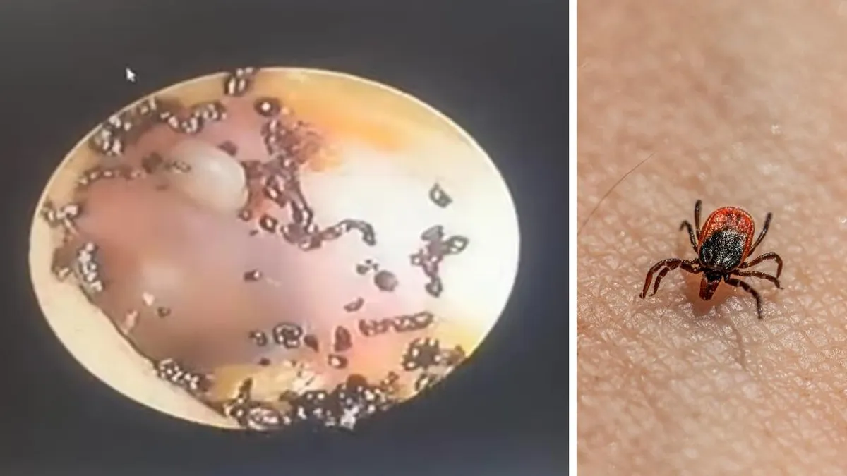Médico halla garrapatas en oído de niña tras semanas de dolor en Malasia.