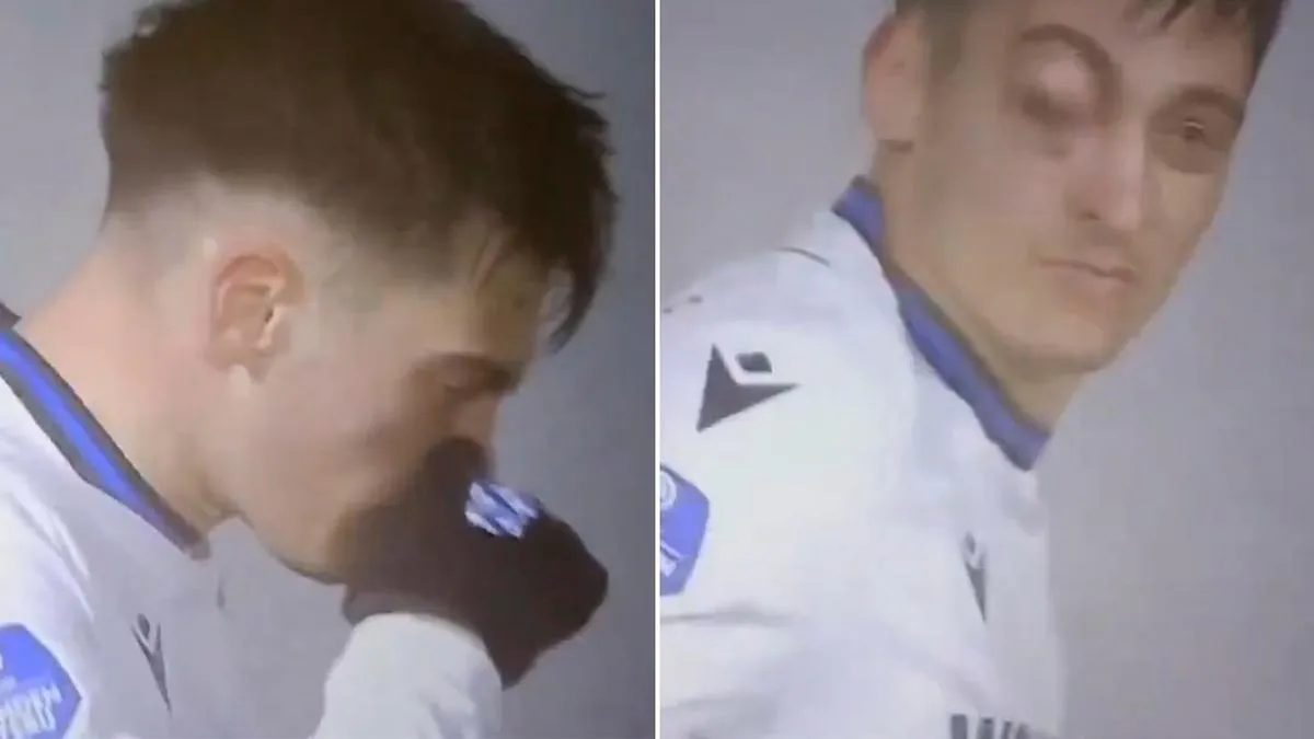 Impactante lesión en el fútbol: un jugador casi pierde un ojo al sonarse la nariz. Impactante lesión en el fútbol: un jugador casi pierde un ojo al sonarse la nariz.
