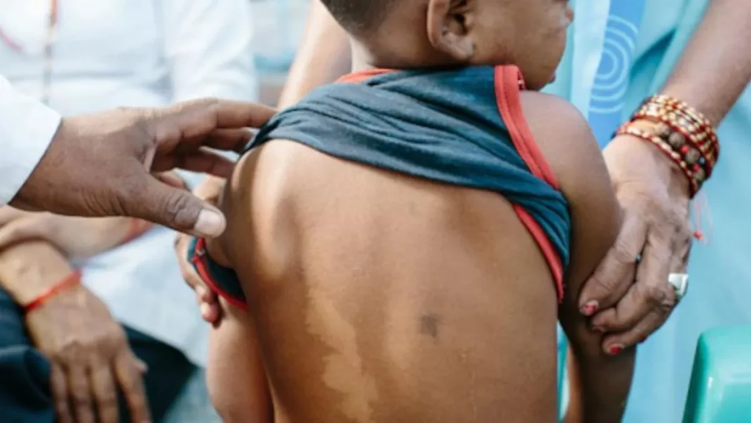 Día Mundial de la Lepra: reflexionamos sobre su impacto y la lucha por erradicarla. Día Mundial de la Lepra: reflexionamos sobre su impacto y la lucha por erradicarla.