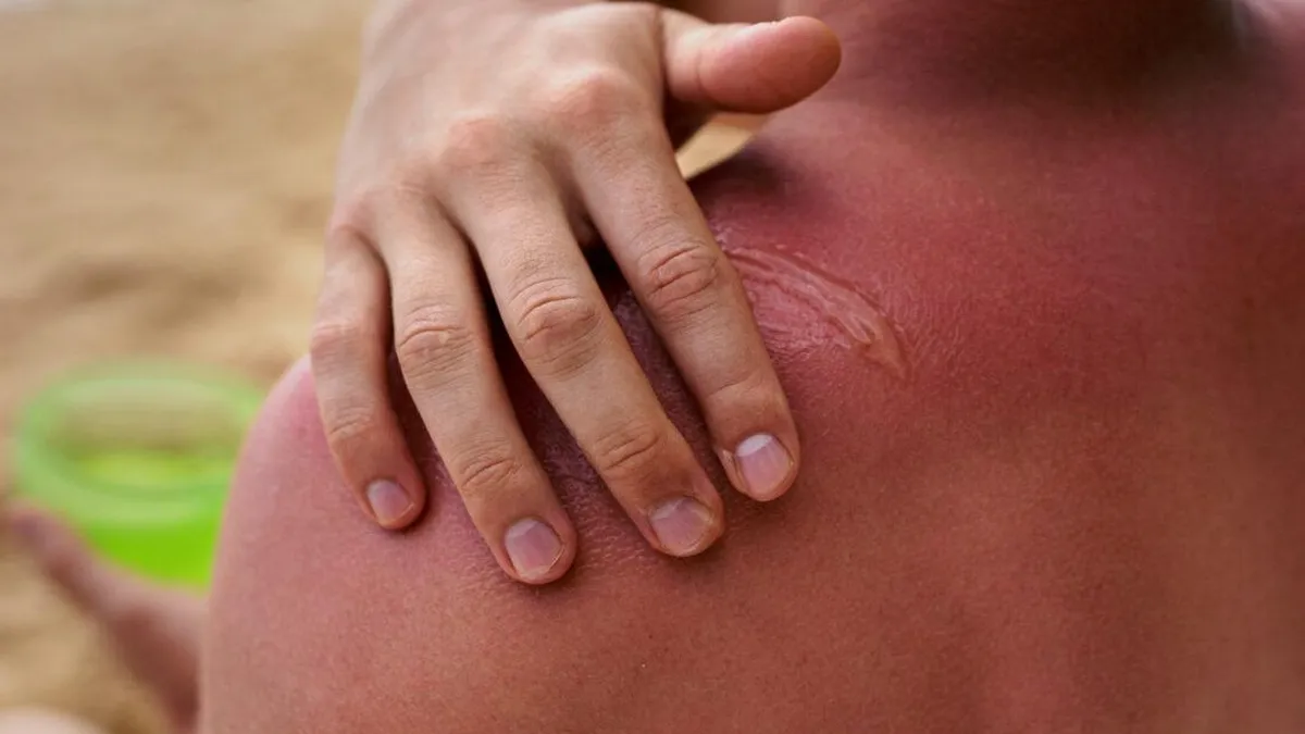 Consejos para tratar quemaduras solares y saber cuándo ver al médico.