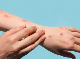 Brasil reporta su primer caso de la variante clado 1b de mpox.