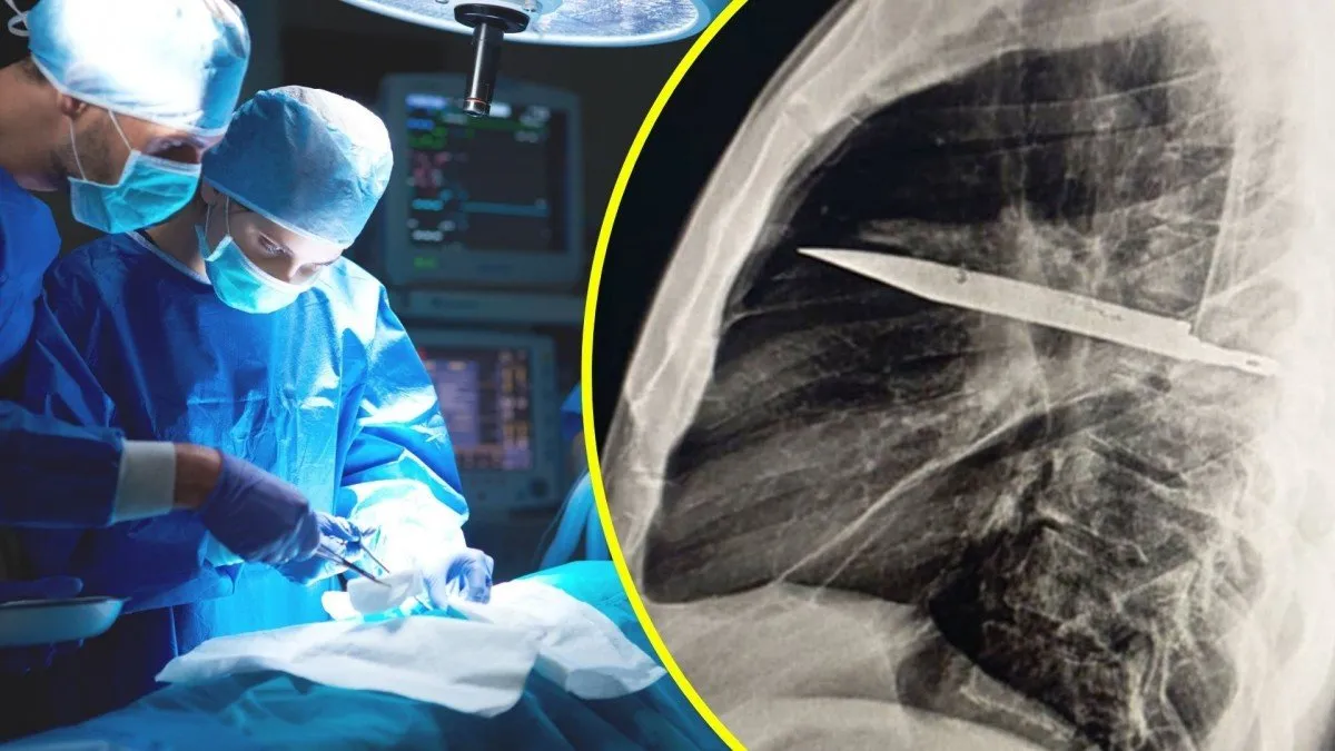 Un hombre descubre un cuchillo enterrado en su pecho tras años de dolor y pus.