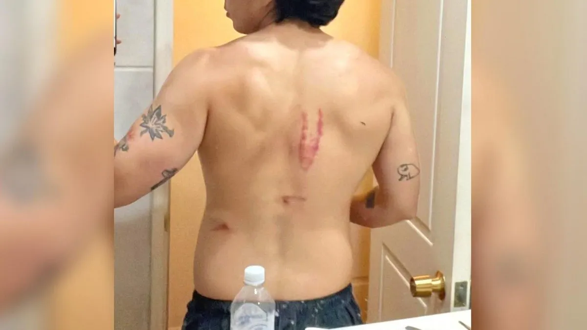 El cantante urbano se lesiona gravemente en la espalda tras una caída en Navidad.