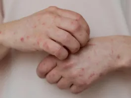 Detectan caso de sarampión importado en Chile tras viaje a Madrid.