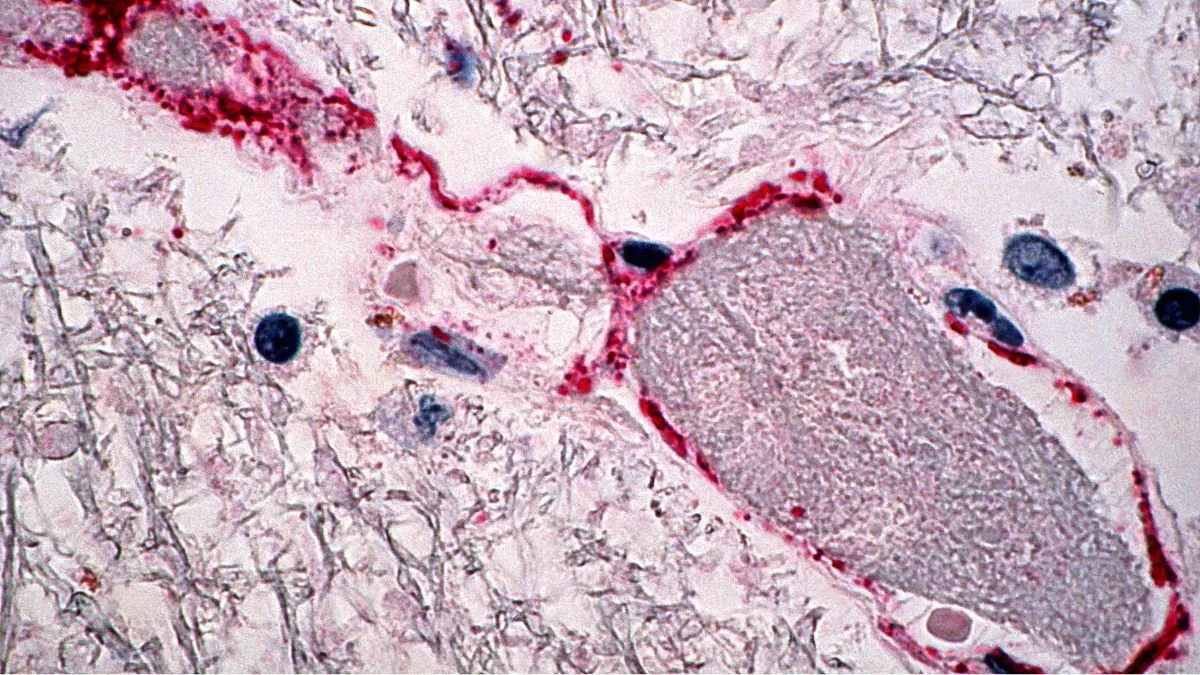 Cinco casos de virus Nipah en Calcuta activan protocolos de vigilancia en Asia.